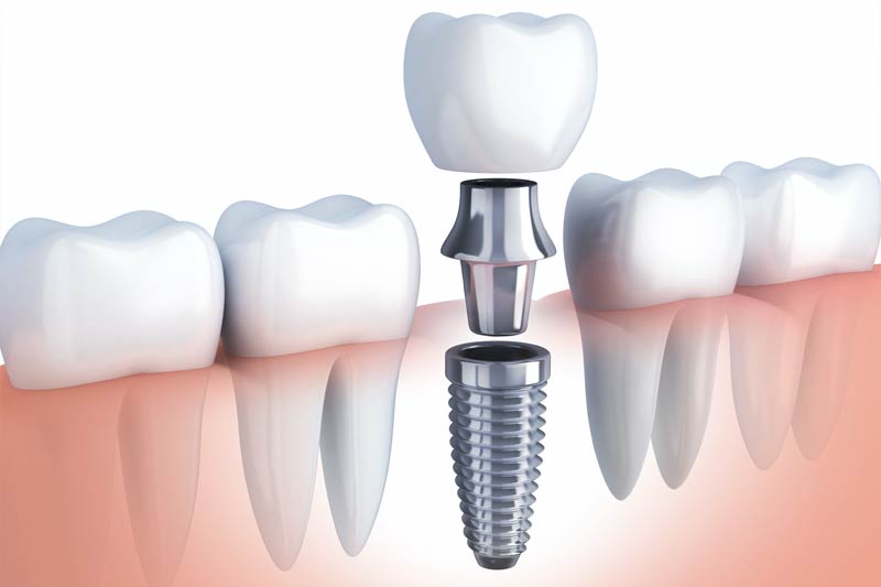 Guided Dental Implants in West Bloomfield