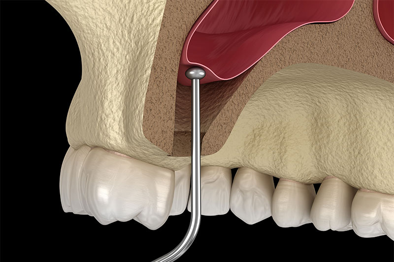 Sinus Augmentation in West Bloomfield